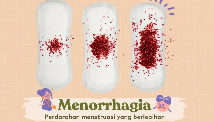 Menoragia Atau Menstruasi Berlebihan Menyebabkan Anemia