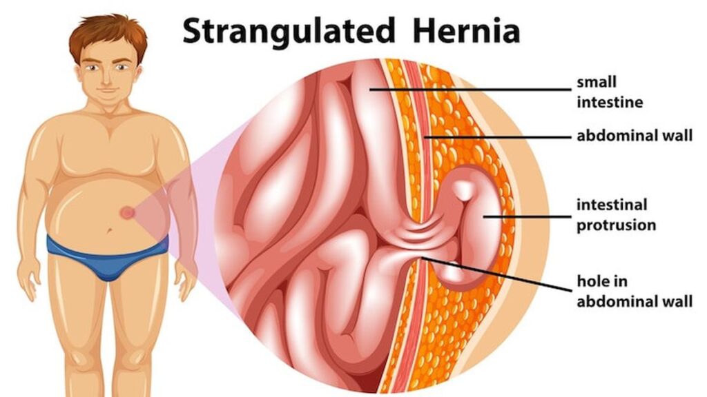 Penyakit Hernia