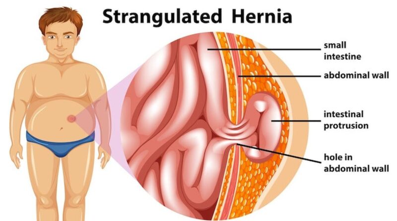 Penyakit Hernia