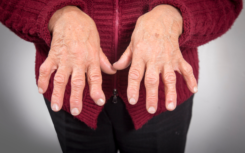 Rheumatoid Arthritis Di Tandai Peradangan Kronis Pada Sendi
