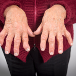 Rheumatoid Arthritis Di Tandai Peradangan Kronis Pada Sendi