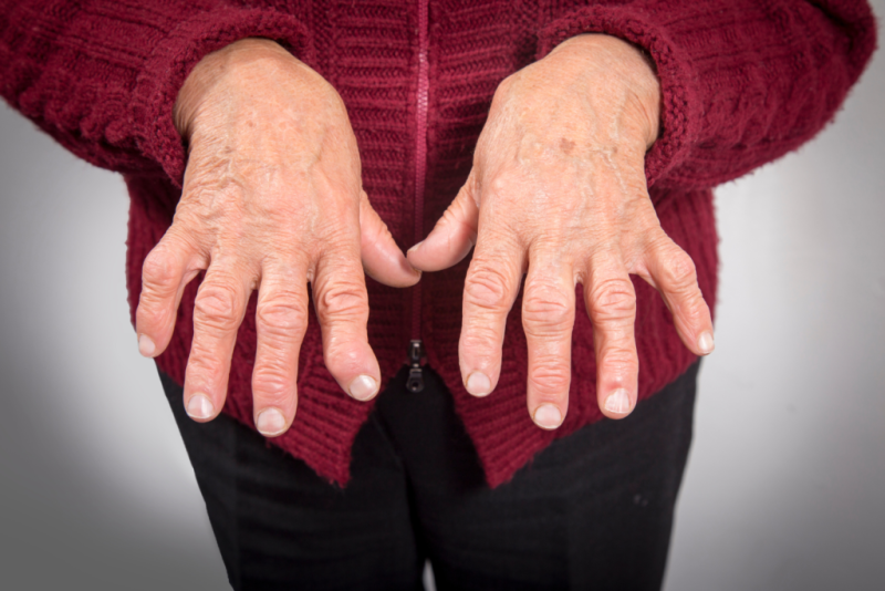 Rheumatoid Arthritis