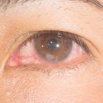 Ulkus Kornea, Luka pada Mata yang Bisa Mengancam Penglihatan