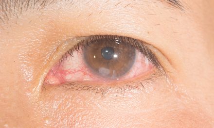 Ulkus Kornea, Luka pada Mata yang Bisa Mengancam Penglihatan