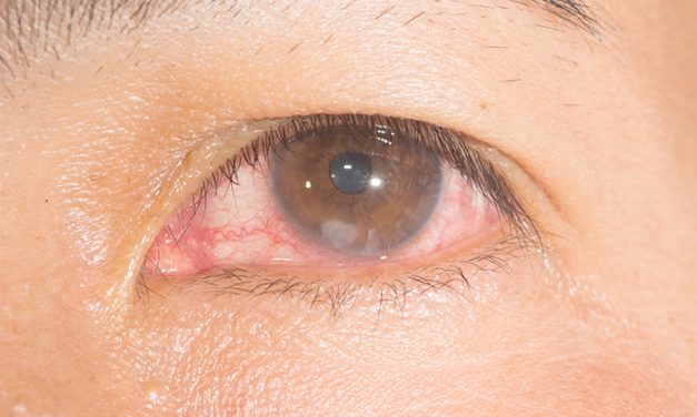 Ulkus Kornea, Luka pada Mata yang Bisa Mengancam Penglihatan