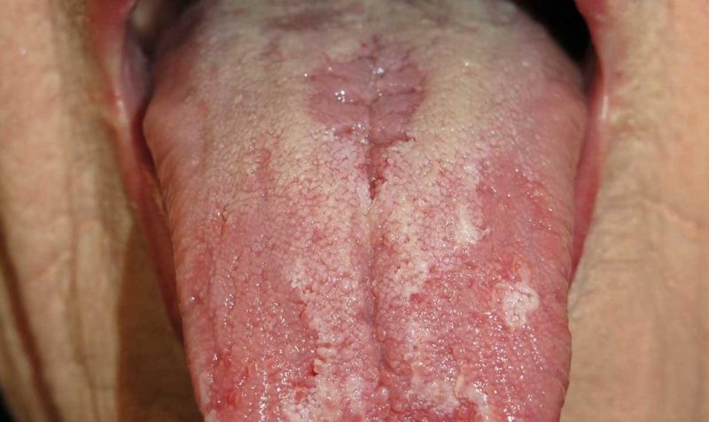 Penyakit Glositis