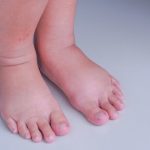 Penyakit Beri Beri Ketika Tubuh Kekurangan Vitamin B1