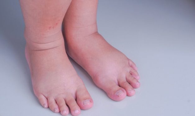 Penyakit Beri Beri Ketika Tubuh Kekurangan Vitamin B1